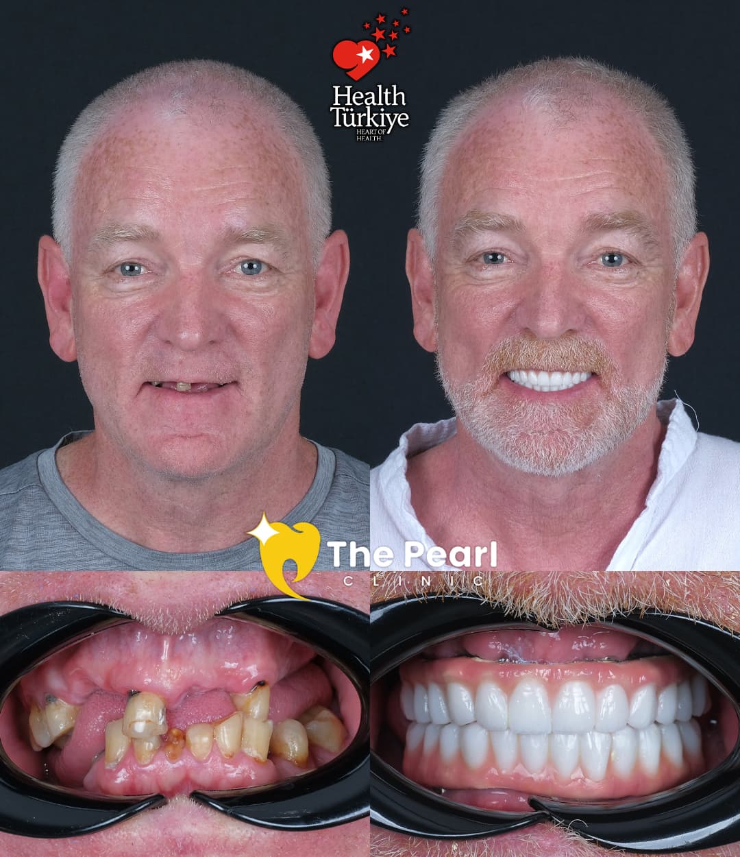 Natural style full arch implant restoration
